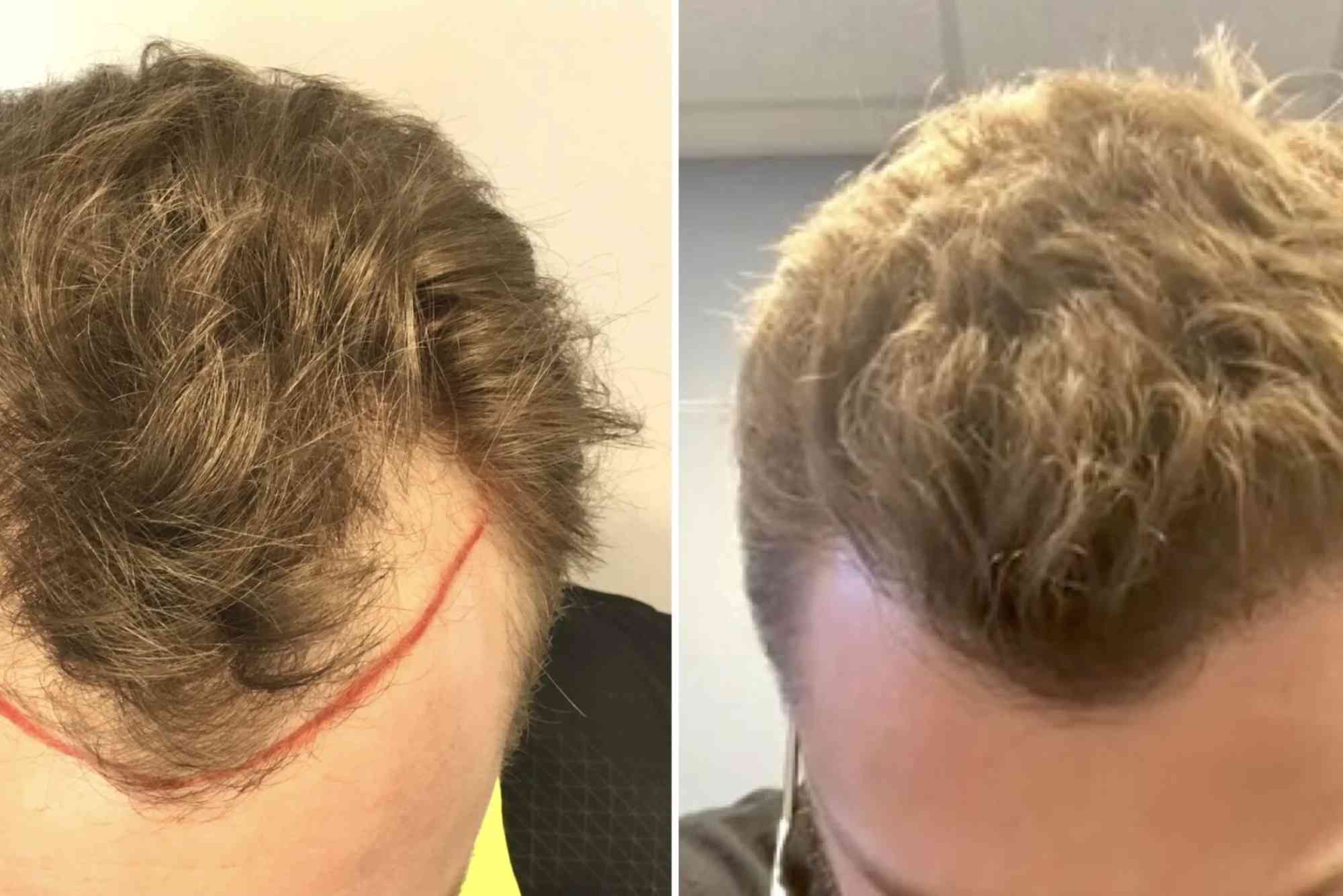 Best Hair Transplat Turkey